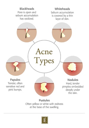 Types of Acne