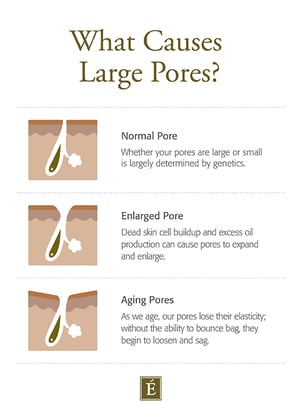 What Causes Large Pores?